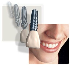 Dental Implants in Myrtle Beach SC